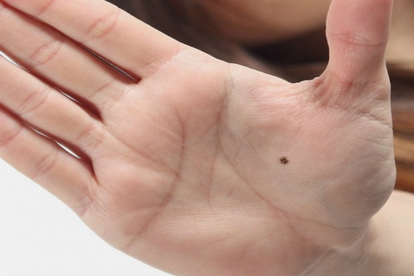 Nốt ruồi ở lòng bàn tay mang đến vận mệnh gì?